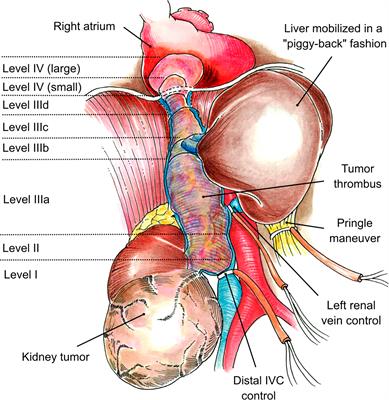 En Bloc Resection of Right Renal Cell Carcinoma and Inferior Vena Cava Tumor Thrombus Without Caval Reconstruction: Is It Safe to Divide the Left Renal Vein?